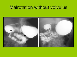 Malrotation without volvulus
 