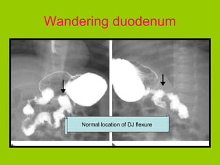 Wandering duodenum




     Normal location of DJ flexure
 