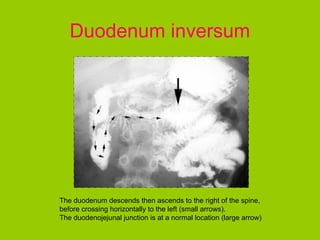 Duodenum inversum




The duodenum descends then ascends to the right of the spine,
before crossing horizontally to the left (small arrows).
The duodenojejunal junction is at a normal location (large arrow)
 