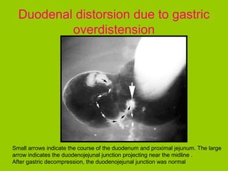 Duodenal distorsion due to gastric
          overdistension




Small arrows indicate the course of the duodenum and proximal jejunum. The large
arrow indicates the duodenojejunal junction projecting near the midline .
After gastric decompression, the duodenojejunal junction was normal
 