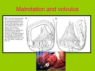 Malrotation and volvulus
 