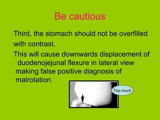 Be cautious
Third, the stomach should not be overfilled
with contrast.
This will cause downwards displacement of
 duodenojejunal flexure in lateral view
making false positive diagnosis of
malrotation.
                               Too much
 