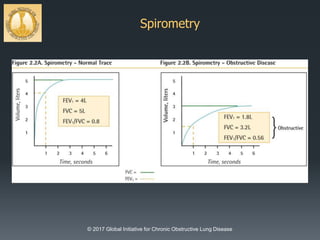 Spirometry
© 2017 Global Initiative for Chronic Obstructive Lung Disease
 