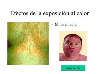 Efectos de la exposición al calor
                 • Miliaria rubra




                          insolación
 