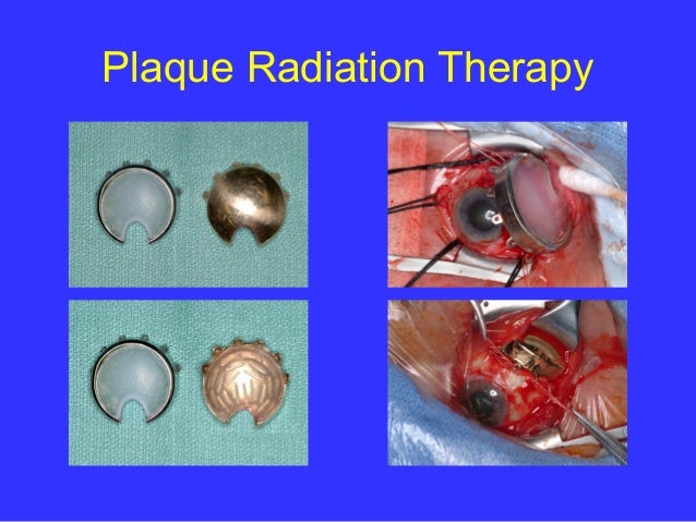 Choroidal melanoma complications blog.manicurex.ru