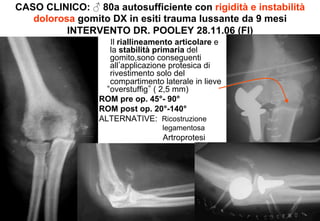 CASO CLINICO: ♂ 80a autosufficiente con rigidità e instabilità
dolorosa gomito DX in esiti trauma lussante da 9 mesi
INTERVENTO DR. POOLEY 28.11.06 (FI)
Il riallineamento articolare e
la stabilità primaria del
gomito,sono conseguenti
all applicazione protesica di
rivestimento solo del
compartimento laterale in lieve
overstuffig ( 2,5 mm)
ROM pre op. 45°- 90°
ROM post op. 20°-140°
ALTERNATIVE: Ricostruzione
legamentosa

Artroprotesi

 