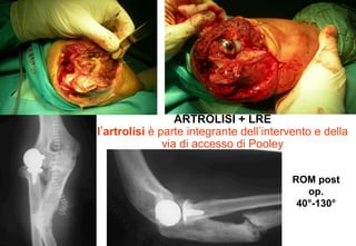 • 
ARTROLISI + LRE
l artrolisi è parte integrante dell intervento e della
via di accesso di Pooley
ROM post
op.
40°-130°

 