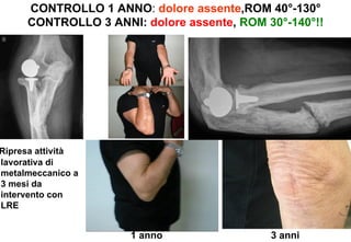 CONTROLLO 1 ANNO: dolore assente,ROM 40°-130°
CONTROLLO 3 ANNI: dolore assente, ROM 30°-140°!!

Ripresa attività
lavorativa di
metalmeccanico a
3 mesi da
intervento con
LRE

1 anno

3 anni

 