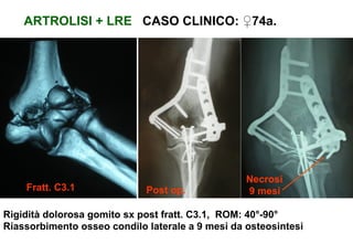 ARTROLISI + LRE CASO CLINICO: ♀74a.

Fratt. C3.1

Post op.

Necrosi
9 mesi

Rigidità dolorosa gomito sx post fratt. C3.1, ROM: 40°-90°
Riassorbimento osseo condilo laterale a 9 mesi da osteosintesi

 