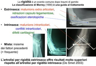 La rigidità è un evento comune dopo traumi di gomito
La classificazione di Morrey (1990) è una guida al trattamento

•  Estrinseca: malunions extra articolari,
retrazioni capsulo legamentose,
ossificazioni eterotopiche
•  Intrinseca: malunions intrarticolari,
conflitti intrarticolari,
difetti cartilaginei

•  Mista: insieme
dei fattori precedenti
(+ frequente)
L artrolisi per rigidità estrinseca offre risultati molto superiori
rispetto all artrolisi per rigidità intrinseca (De Smet 2003)

 