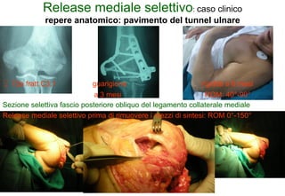 Release mediale selettivo: caso clinico
repere anatomico: pavimento del tunnel ulnare

♀ 72a fratt C3.1

guarigione

rigidità a 6 mesi

a 3 mesi
ROM: 40°-90°
Sezione selettiva fascio posteriore obliquo del legamento collaterale mediale
Release mediale selettivo prima di rimuovere i mezzi di sintesi: ROM 0°-150°

 