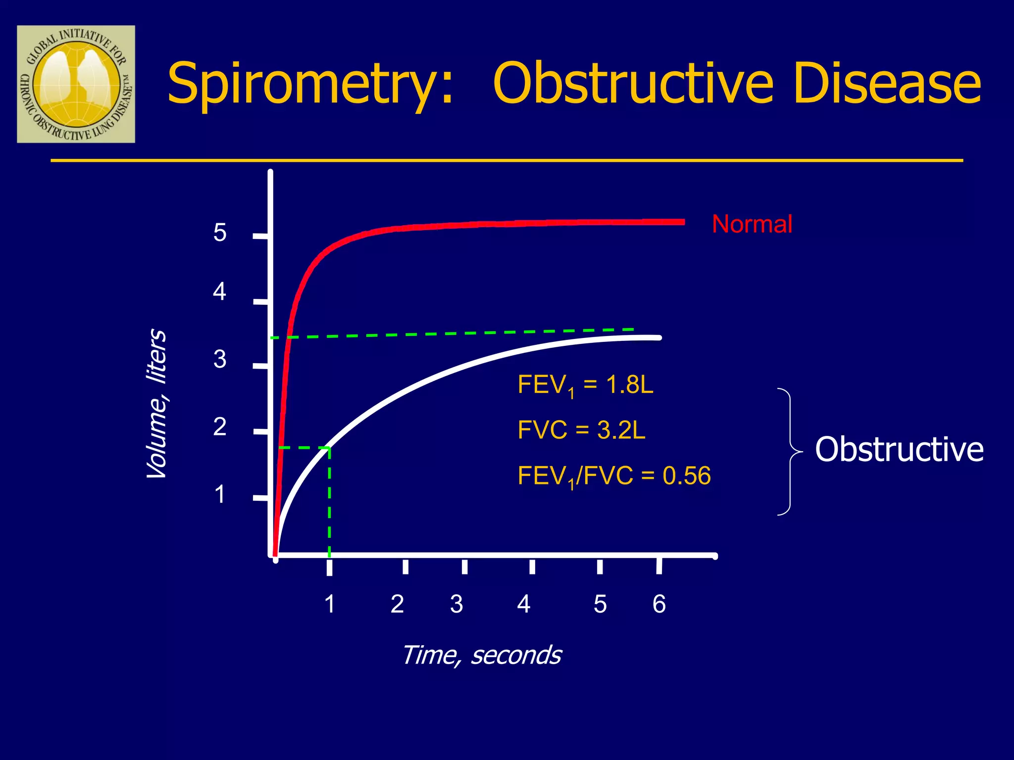 Spirometry: Obstructive Disease
Volume,liters
Time, seconds
5
4
3
2
1
1 2 3 4 5 6
FEV1 = 1.8L
FVC = 3.2L
FEV1/FVC = 0.56
Normal
Obstructive
 