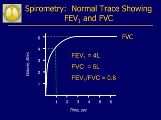 Spirometry: Normal Trace Showing
FEV1 and FVC
1 2 3 4 5 6
1
2
3
4
Volume,liters
Time, sec
FVC5
1
FEV1 = 4L
FVC = 5L
FEV1/FVC = 0.8
 