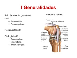 I Generalidades
Articulación más grande del
cuerpo.
– Femoro-tibial
– Femoro-patelar

Flexión/extensión
Etiología lesión:
...
