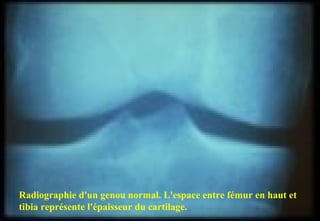 Radiographie d'un genou normal. L'espace entre fémur en haut et
tibia représente l'épaisseur du cartilage.
 