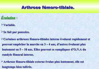 Arthrose fémoro-tibiale.Arthrose fémoro-tibiale.
ÉvolutionÉvolution ::
Variable.Variable.
Se fait par poussées.Se fait par poussées.
Certaines arthroses fémoro-tibiales interne évoluent rapidement etCertaines arthroses fémoro-tibiales interne évoluent rapidement et
peuvent empêcher la marche en 3 – 4 ans, d’autres évoluent pluspeuvent empêcher la marche en 3 – 4 ans, d’autres évoluent plus
lentement en 5 – 10 ans. Elles peuvent se compliquer d’O.N.A dulentement en 5 – 10 ans. Elles peuvent se compliquer d’O.N.A du
condyle fémoral interne.condyle fémoral interne.
Arthrose fémoro-tibiale externe évolue plus lentement, elle estArthrose fémoro-tibiale externe évolue plus lentement, elle est
longtemps bien tolérée.longtemps bien tolérée.
 