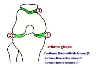-l’arthrose fémoro-tibiale interne (1)l’arthrose fémoro-tibiale interne (1)
- l’arthrose fémoro-tibial externe (2)l’arthrose fémoro-tibial externe (2)
- l’arthrose fémoro-patellaire (3)- l’arthrose fémoro-patellaire (3)
arthrose globalearthrose globale
 