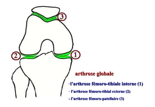 -l’arthrose fémoro-tibiale interne (1)l’arthrose fémoro-tibiale interne (1)
- l’arthrose fémoro-tibial externe (2)l’arthro...