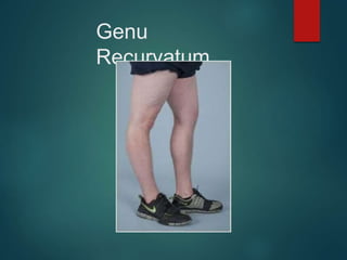 Genu
Recurvatum
 
