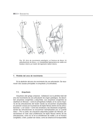 GONIOMETRÍA26
Fig. 29: Arco de movimiento patológico: a) fractura de fémur; b)
pseudoartrosis de fémur, y c) inestabilidad ligamentaria de rodilla con
bostezo interno por lesión del ligamento lateral interno.
7. Pérdida del arco de movimiento
Es la abolición del arco de movimiento de una articulación. Se reco-
nocen dos causas principales: la anquilosis y la artrodesis.
7.1. Anquilosis
Anquilosis (del griego ankylosis, ‘soldadura’) es la pérdida total del
arco de movimiento de una articulación de origen patológico. Se descri-
ben anquilosis congénitas y adquiridas. Las anquilosis congénitas se
clasifican en fibrosas —como la artrogrifosis múltiple, en la cual la mayo-
ría de las articulaciones del recién nacido se encuentran anquilosadas
en posición viciosa por la presencia de tejido fibroso dentro de las articu-
laciones— y en óseas —como las sinostosis y las disostosis congénitas,
donde las articulaciones se encuentran reemplazadas por un puente
óseo—. Por su parte, las anquilosis adquiridas pueden ser fibrosas, ob-
servándose en este caso proliferación de tejido fibroso dentro de las
articulaciones, como se ve en la artrofibrosis de rodilla y en el hombro
congelado, o bien, pueden ser óseas, como se observa en la espondilitis
 