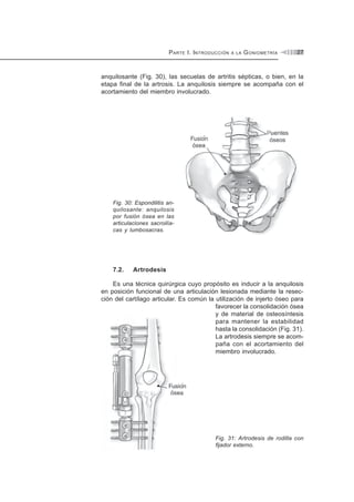 PARTE I. INTRODUCCIÓN A LA GONIOMETRÍA 27
anquilosante (Fig. 30), las secuelas de artritis sépticas, o bien, en la
etapa final de la artrosis. La anquilosis siempre se acompaña con el
acortamiento del miembro involucrado.
Fig. 30: Espondilitis an-
quilosante: anquilosis
por fusión ósea en las
articulaciones sacroilía-
cas y lumbosacras.
7.2. Artrodesis
Es una técnica quirúrgica cuyo propósito es inducir a la anquilosis
en posición funcional de una articulación lesionada mediante la resec-
ción del cartílago articular. Es común la utilización de injerto óseo para
favorecer la consolidación ósea
y de material de osteosíntesis
para mantener la estabilidad
hasta la consolidación (Fig. 31).
La artrodesis siempre se acom-
paña con el acortamiento del
miembro involucrado.
Fig. 31: Artrodesis de rodilla con
fijador externo.
 