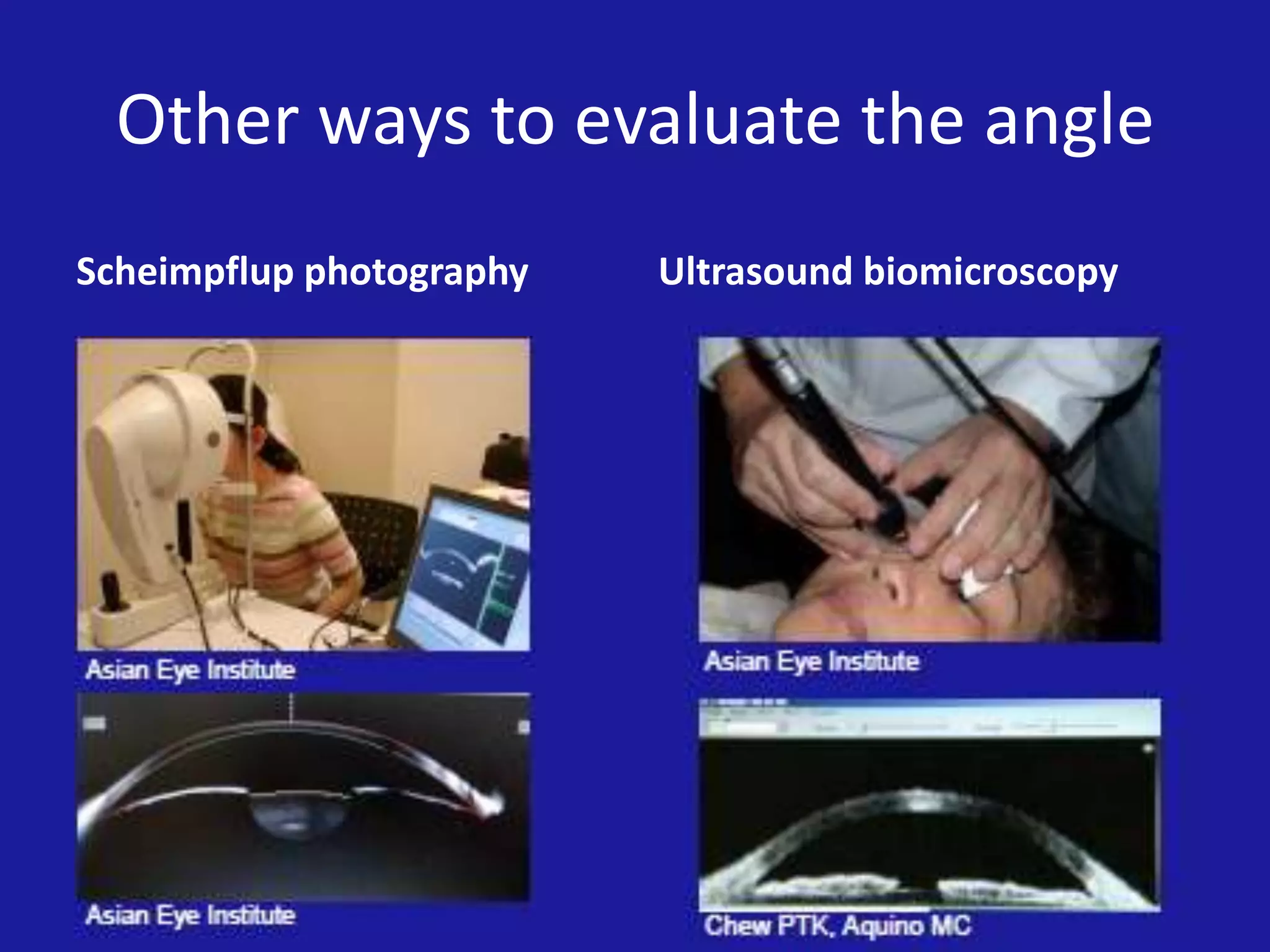 Other ways to evaluate the angle
Scheimpflup photography

Ultrasound biomicroscopy

 