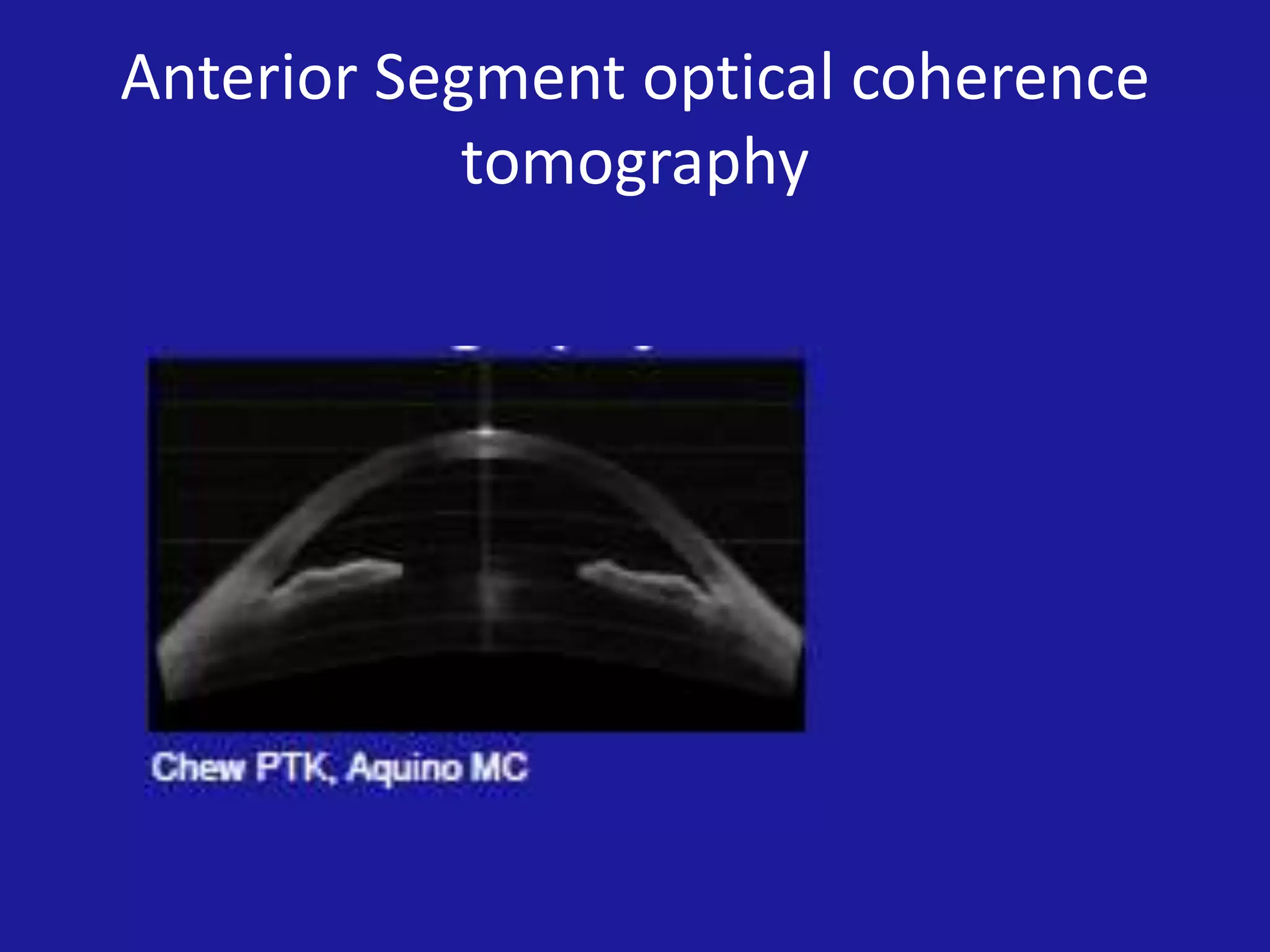 Anterior Segment optical coherence
tomography

 