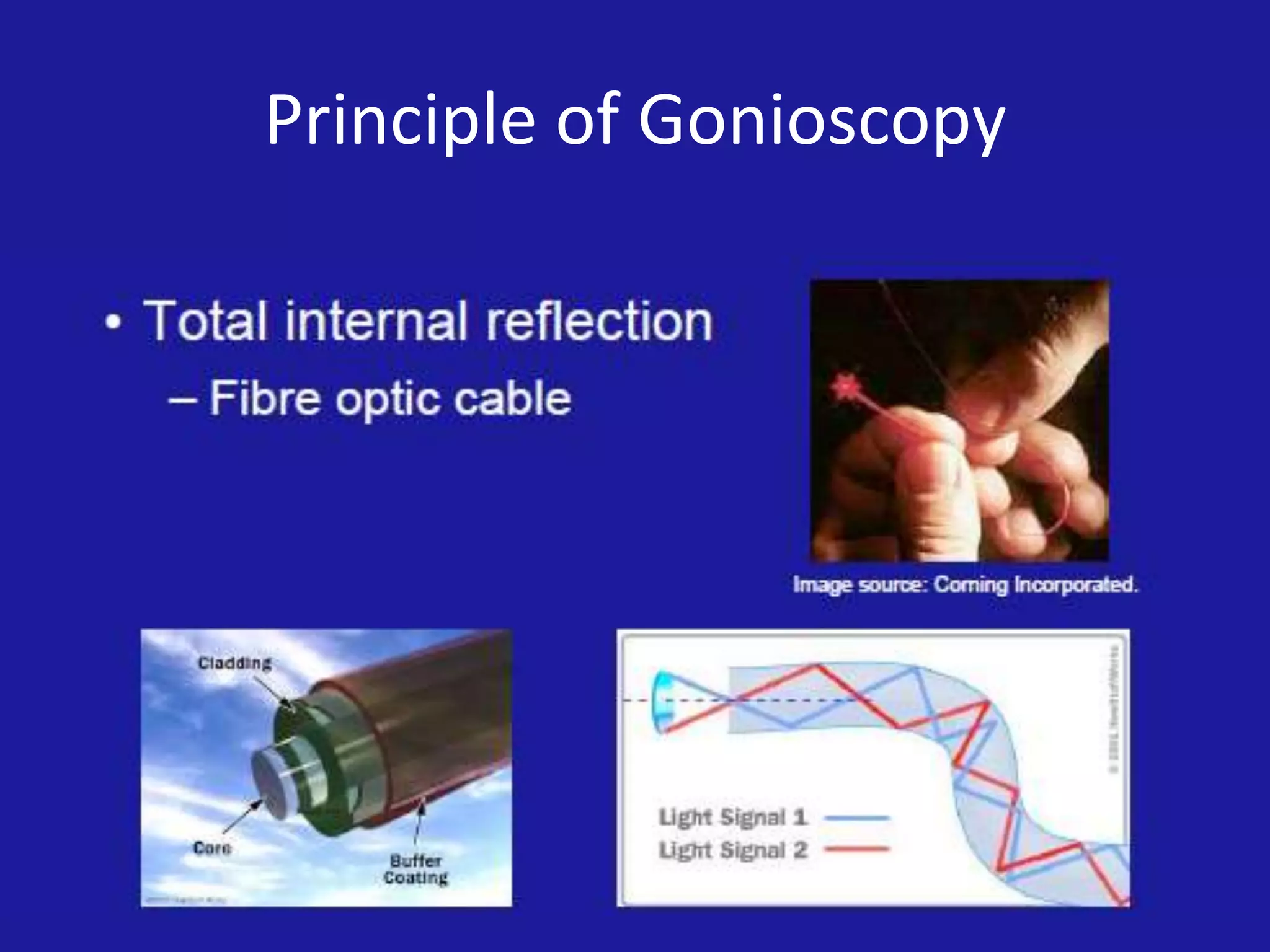 Principle of Gonioscopy

 