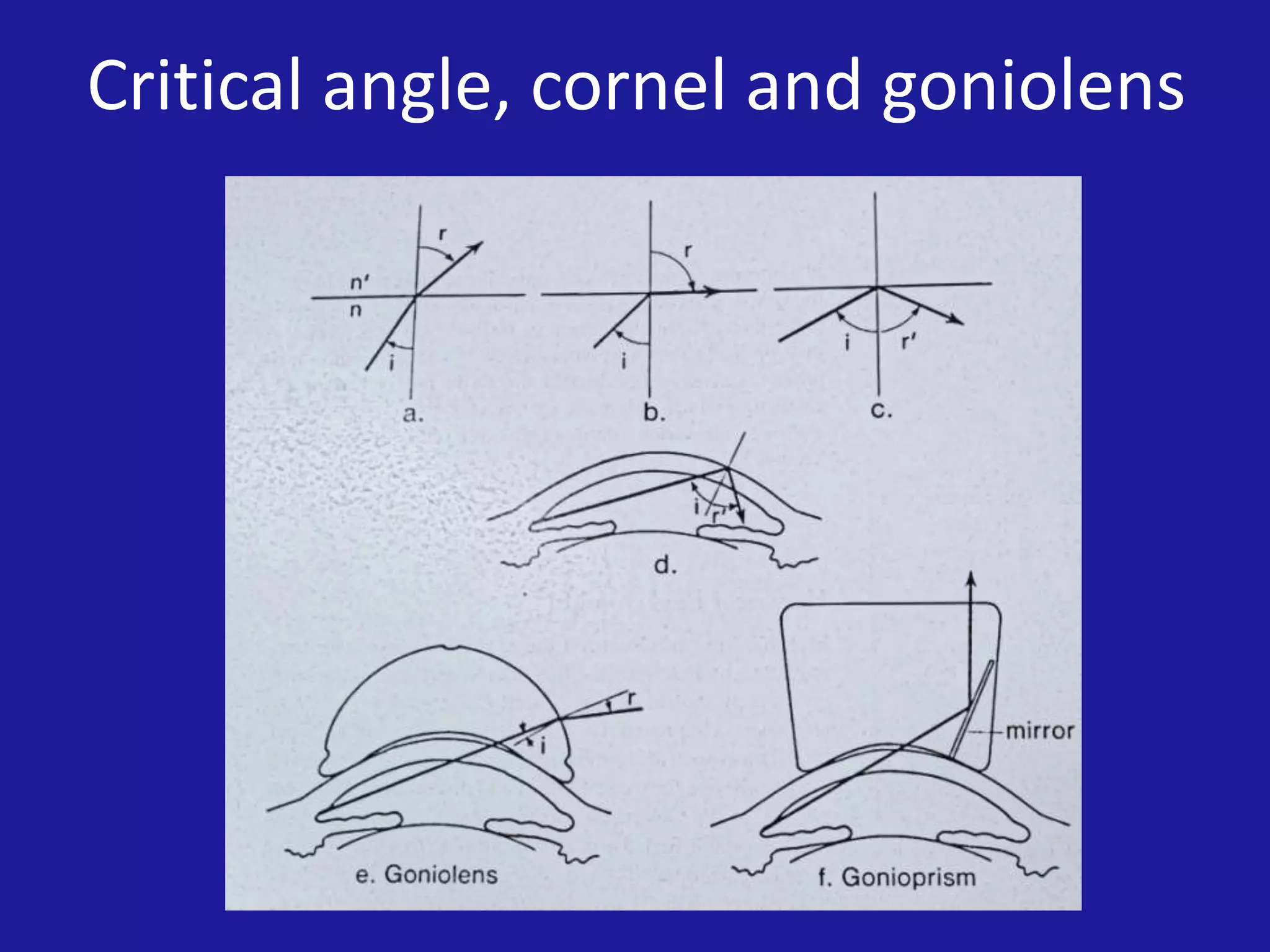 Critical angle, cornel and goniolens

 