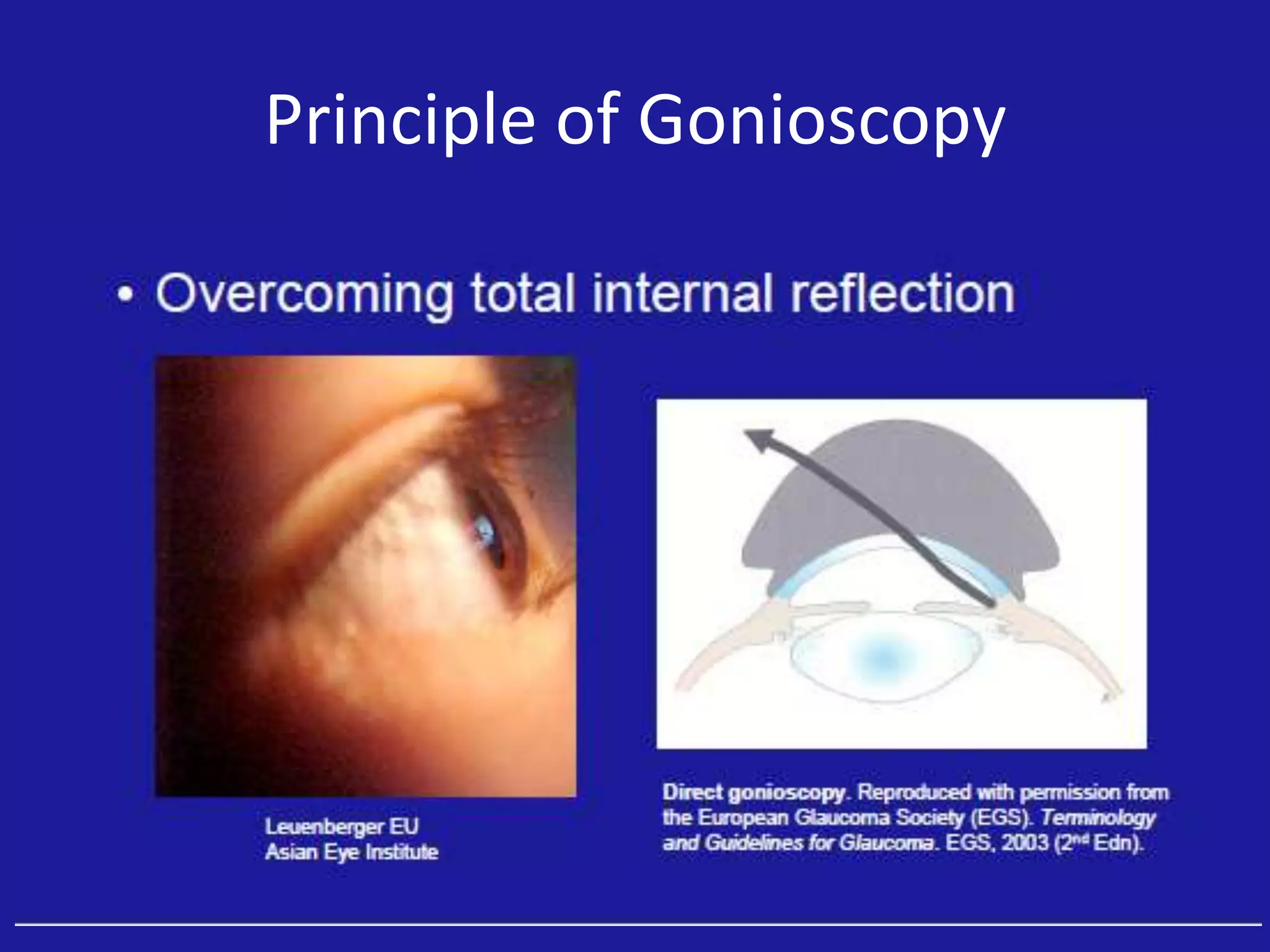 Principle of Gonioscopy

 