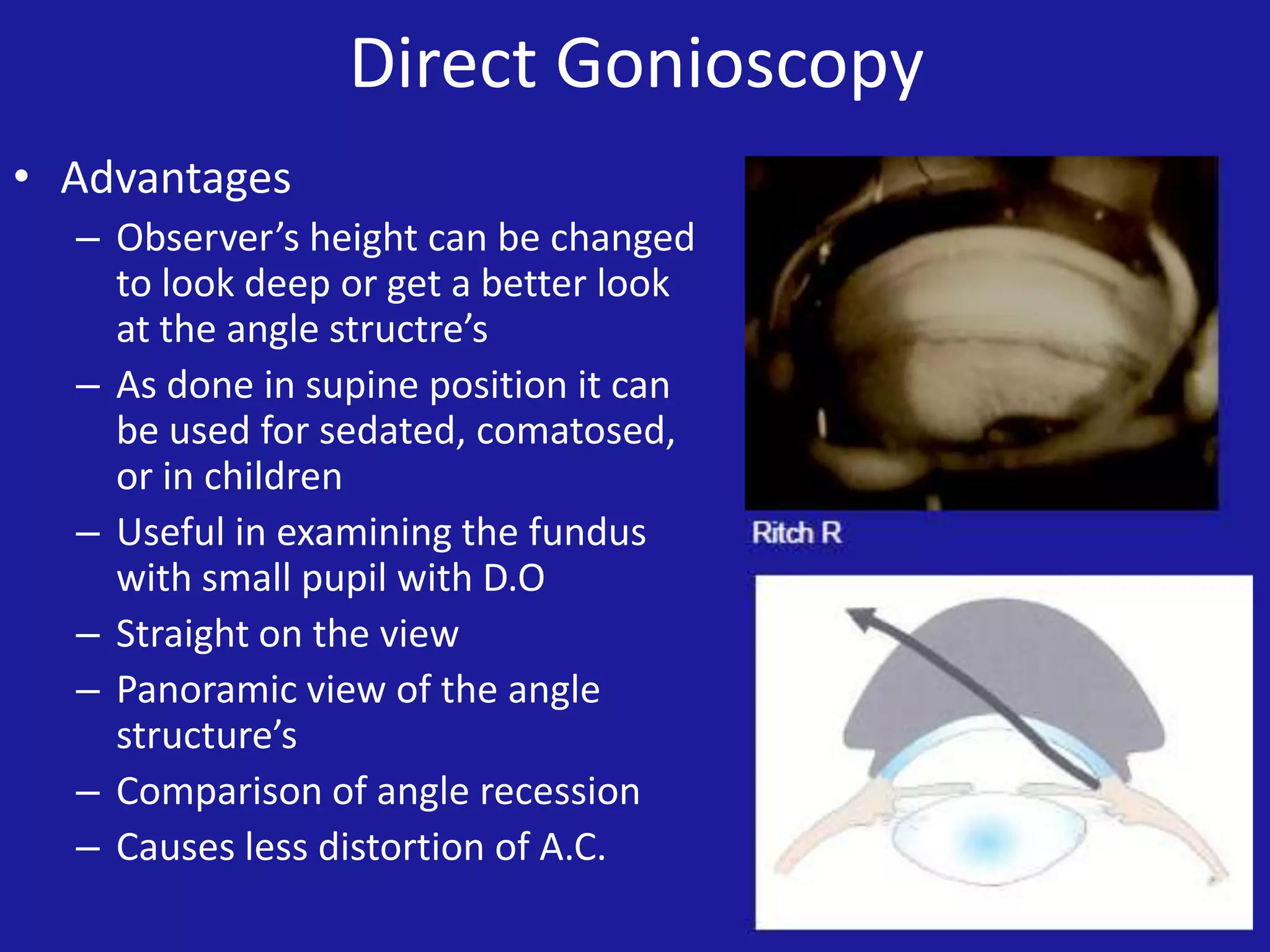Direct Gonioscopy
• Advantages
– Observer’s height can be changed
to look deep or get a better look
at the angle structre’s
– As done in supine position it can
be used for sedated, comatosed,
or in children
– Useful in examining the fundus
with small pupil with D.O
– Straight on the view
– Panoramic view of the angle
structure’s
– Comparison of angle recession
– Causes less distortion of A.C.

 