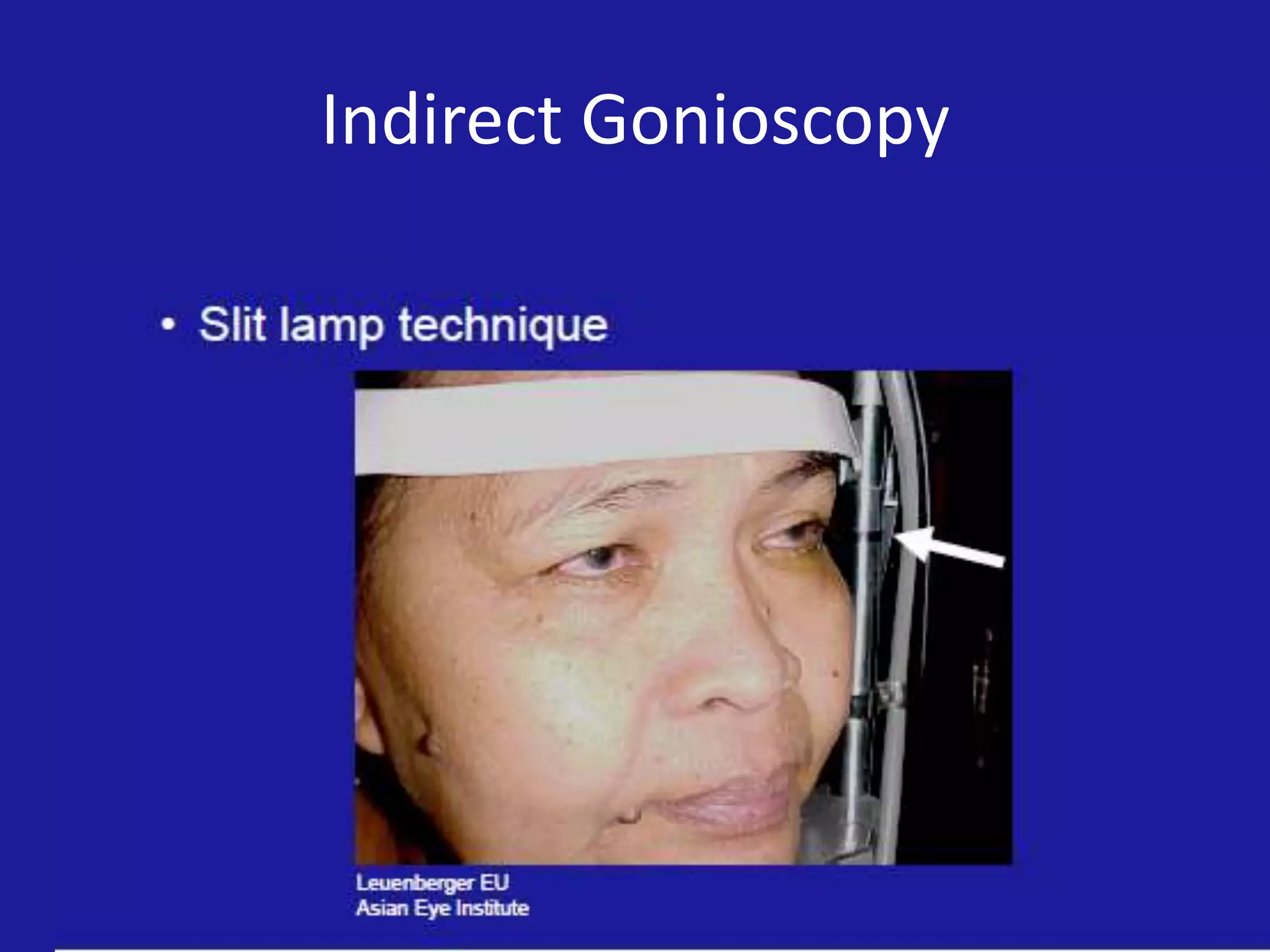 Indirect Gonioscopy

 
