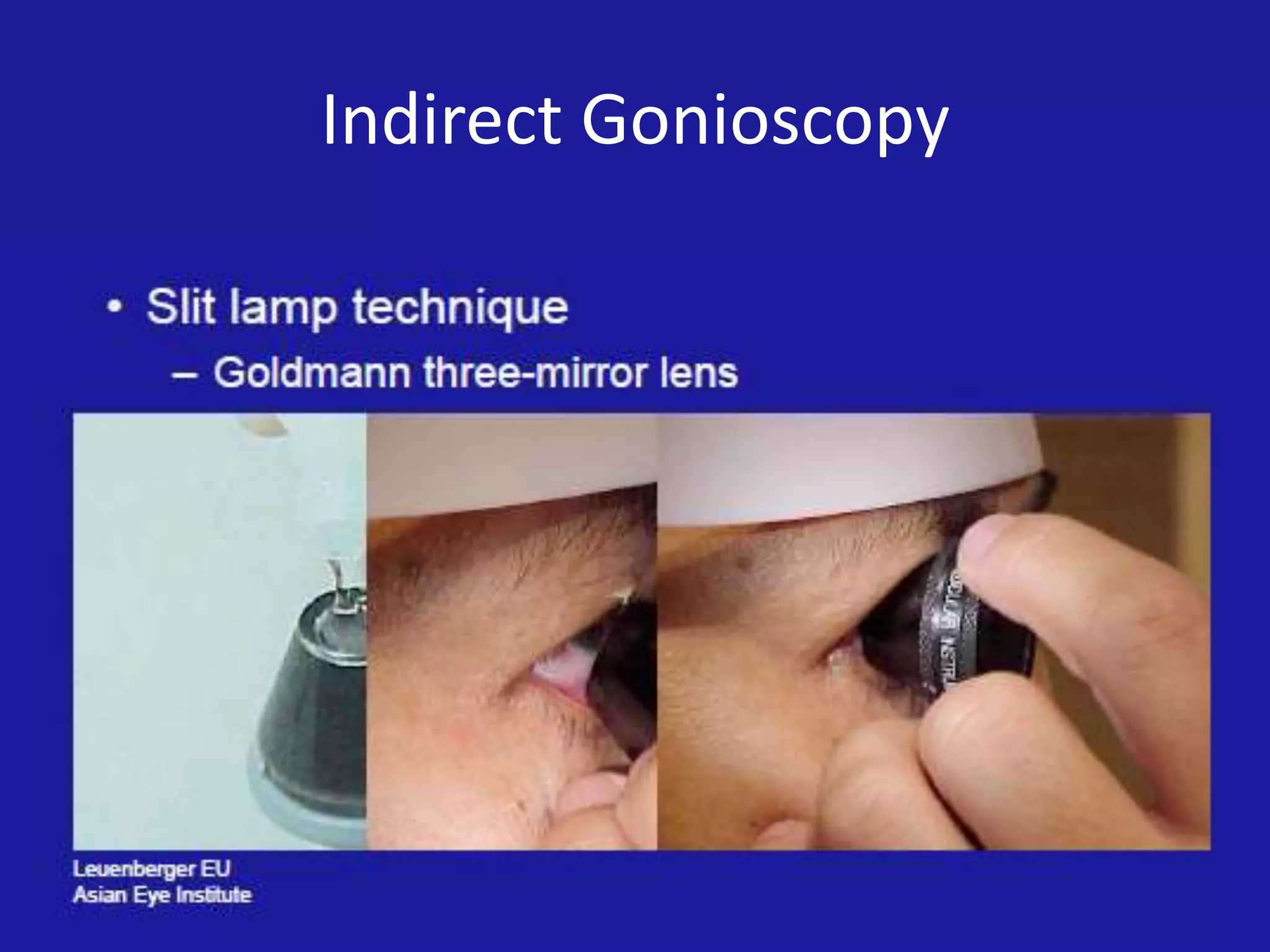 Indirect Gonioscopy

 