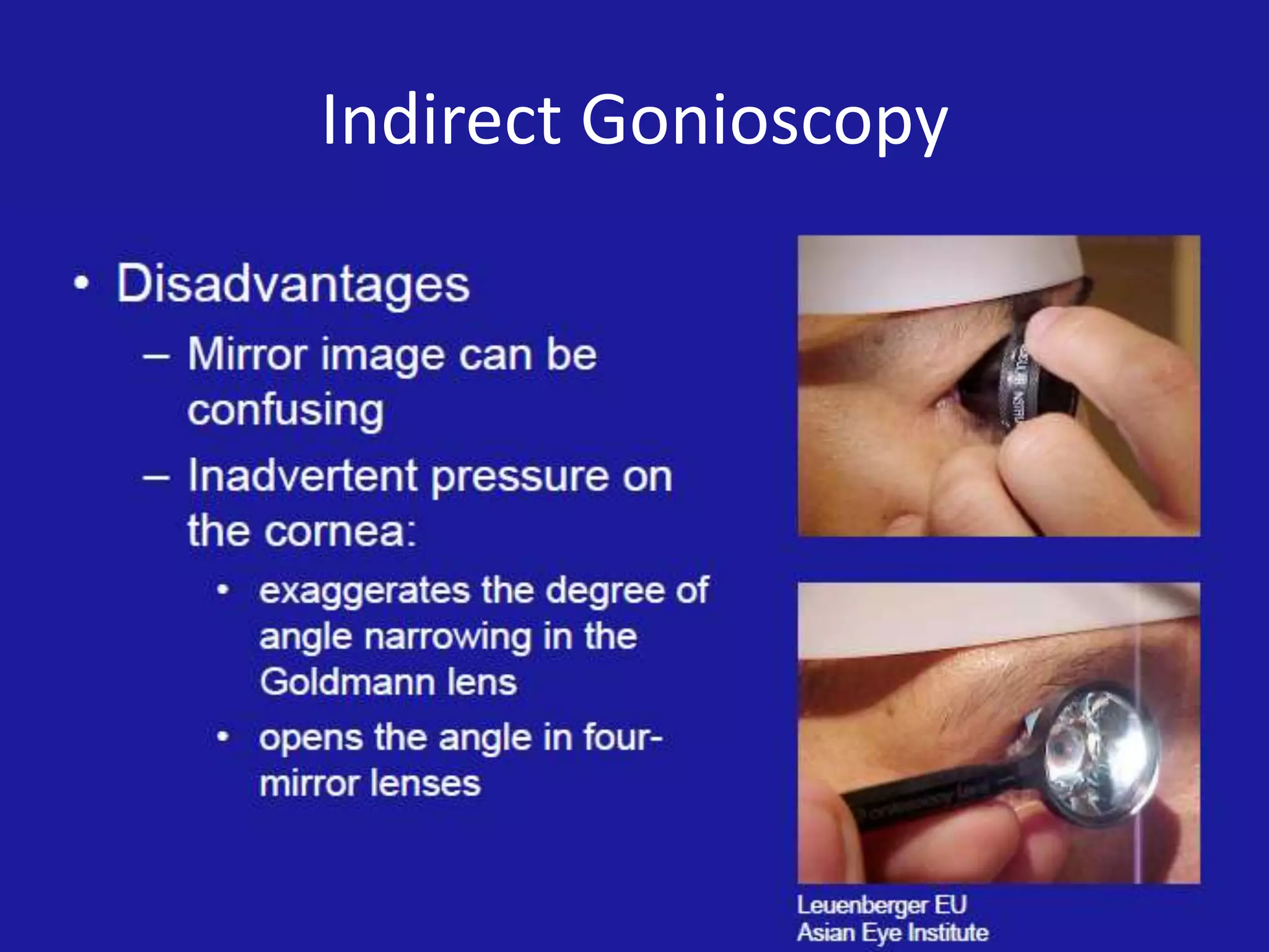 Indirect Gonioscopy

 
