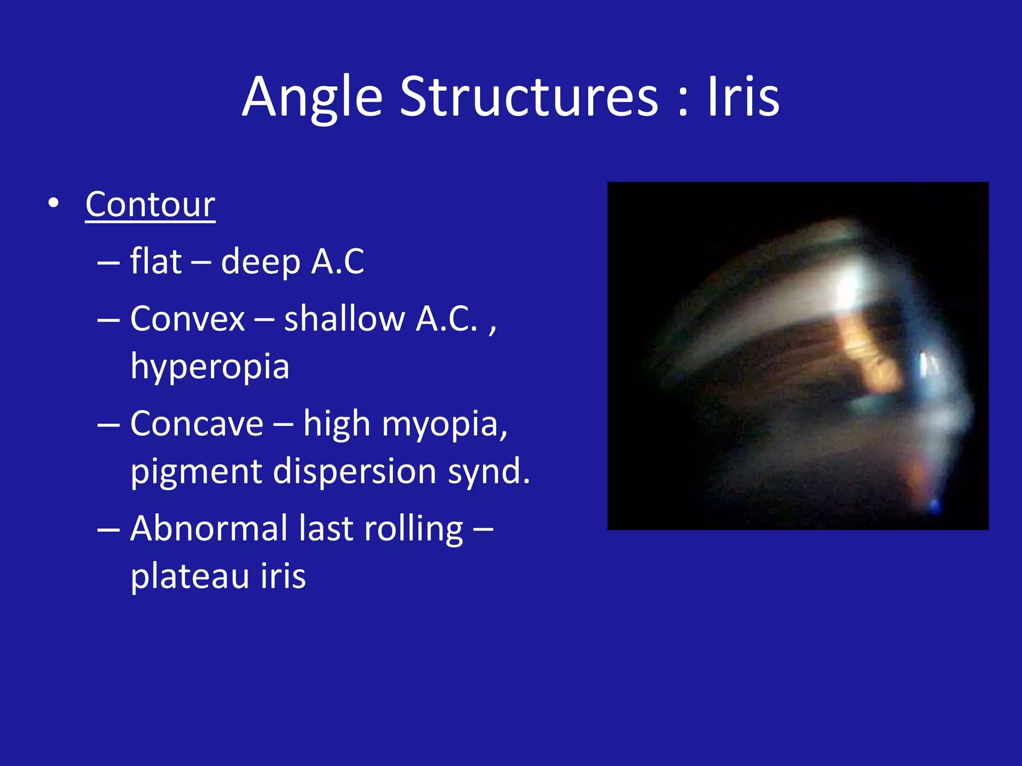 Angle Structures : Iris
• Contour
– flat – deep A.C
– Convex – shallow A.C. ,
hyperopia
– Concave – high myopia,
pigment dispersion synd.
– Abnormal last rolling –
plateau iris

 