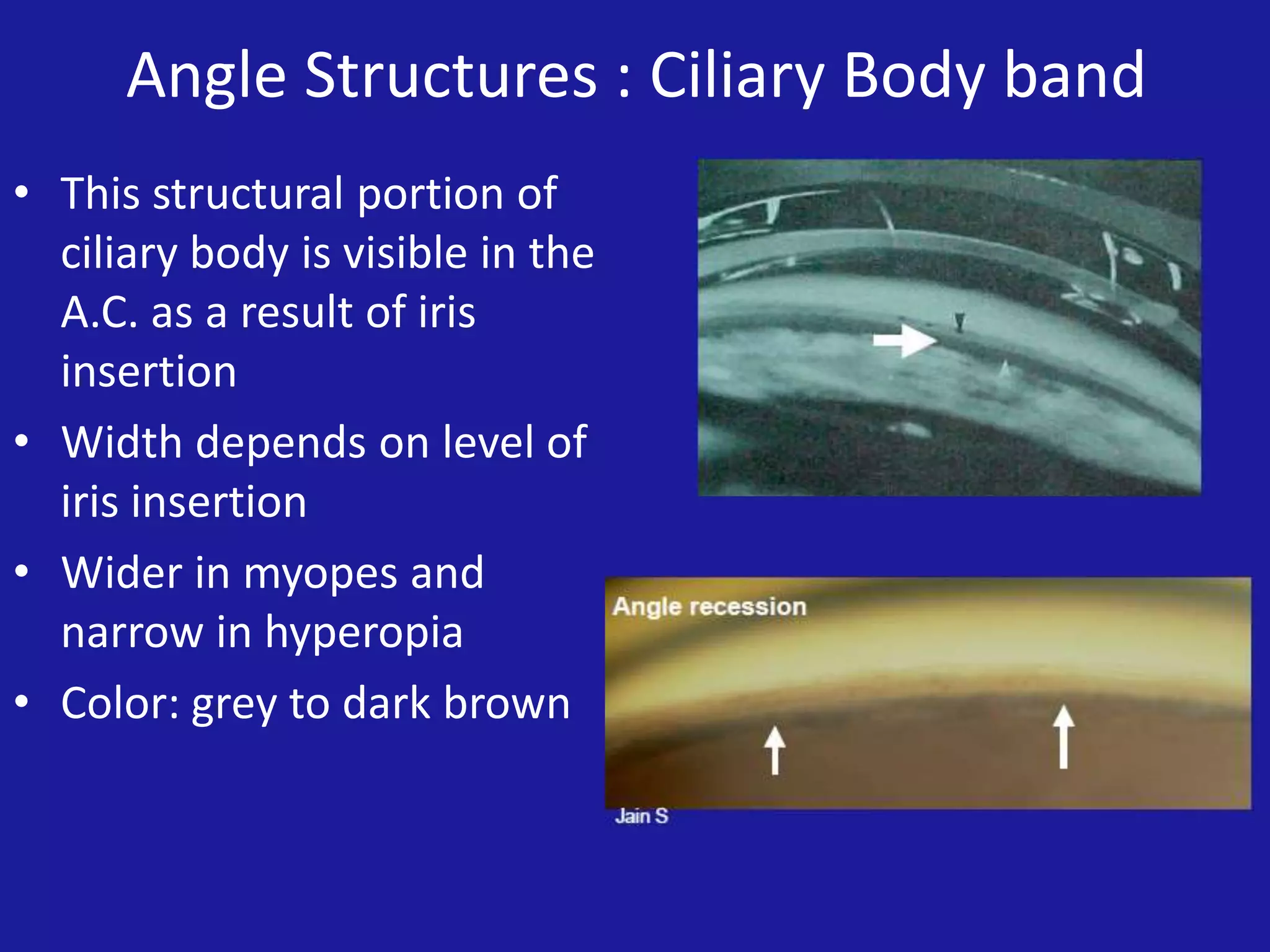 Angle Structures : Ciliary Body band
• This structural portion of
ciliary body is visible in the
A.C. as a result of iris
insertion
• Width depends on level of
iris insertion
• Wider in myopes and
narrow in hyperopia
• Color: grey to dark brown

 