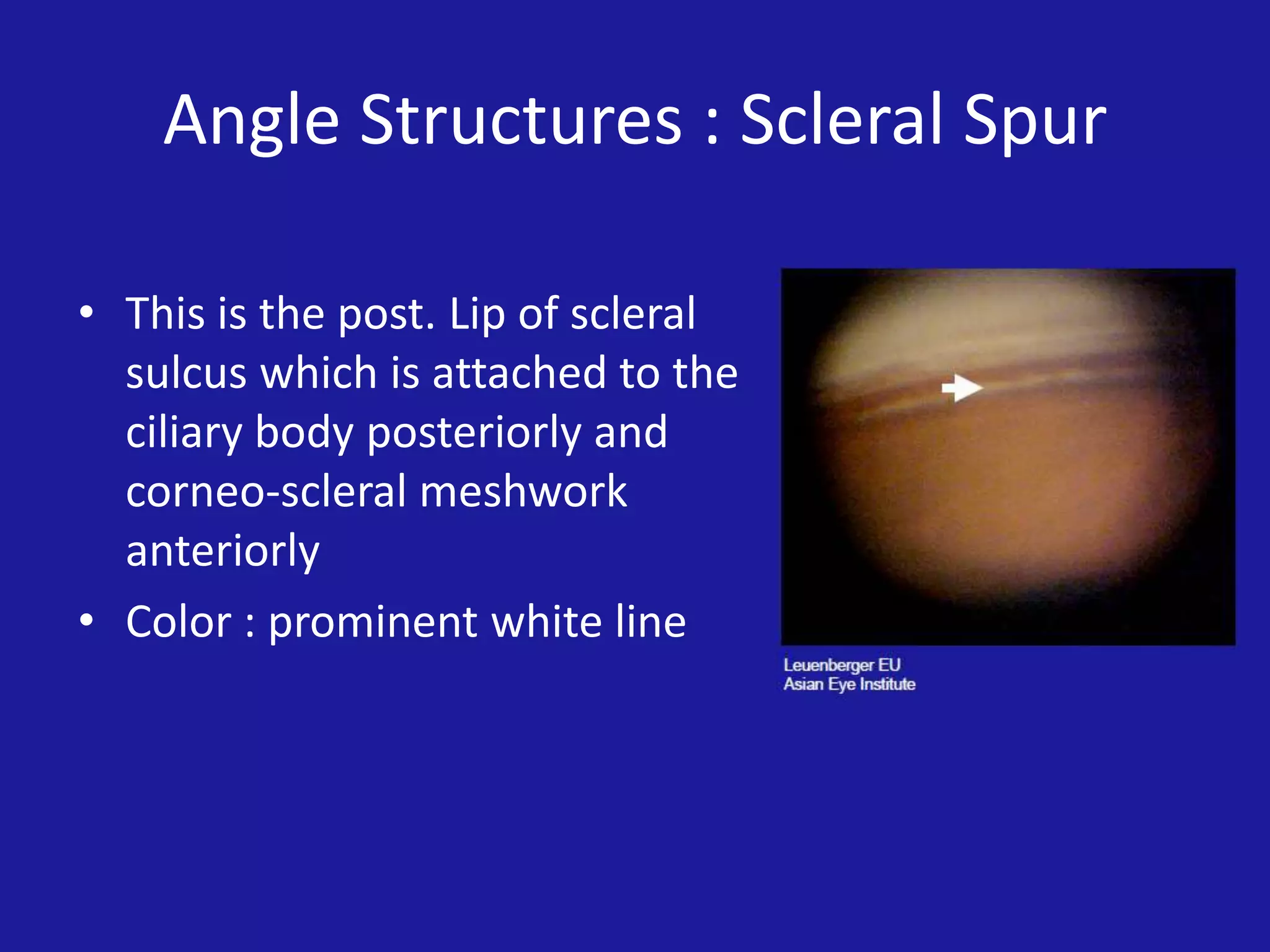 Angle Structures : Scleral Spur
• This is the post. Lip of scleral
sulcus which is attached to the
ciliary body posteriorly and
corneo-scleral meshwork
anteriorly
• Color : prominent white line

 