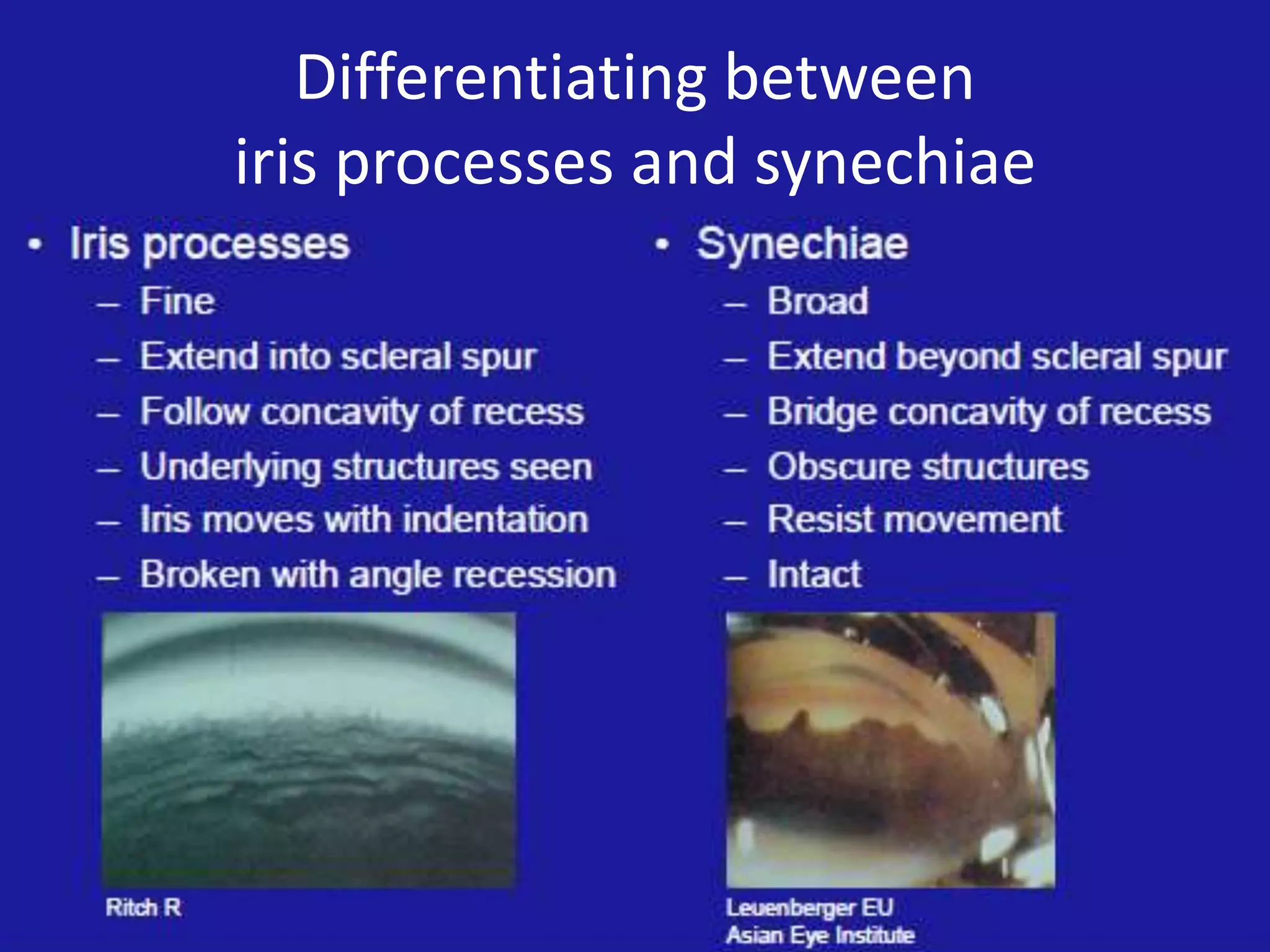 Differentiating between
iris processes and synechiae

 