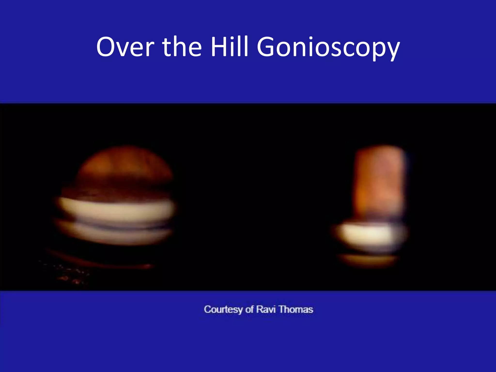 Over the Hill Gonioscopy

 