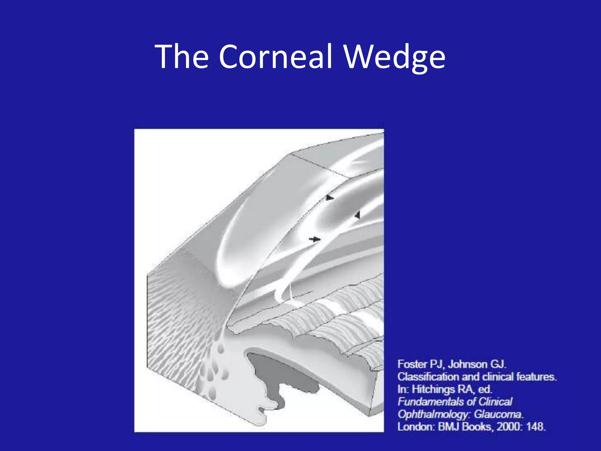 The Corneal Wedge

 