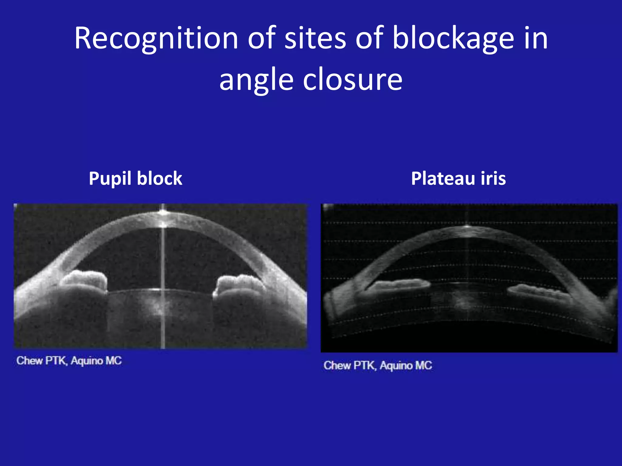 Recognition of sites of blockage in
angle closure
Pupil block

Plateau iris

 