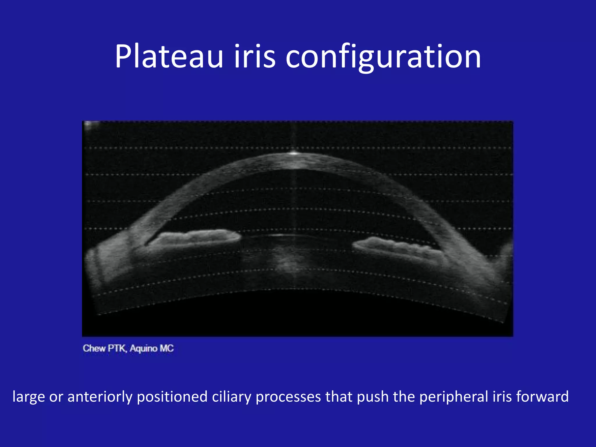 Plateau iris configuration

large or anteriorly positioned ciliary processes that push the peripheral iris forward

 