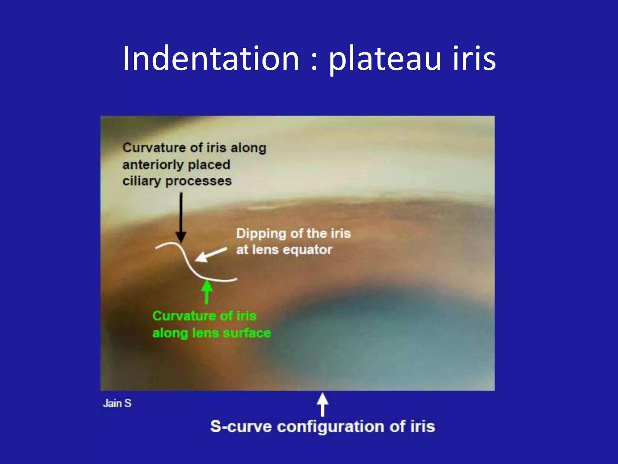 Indentation : plateau iris

 