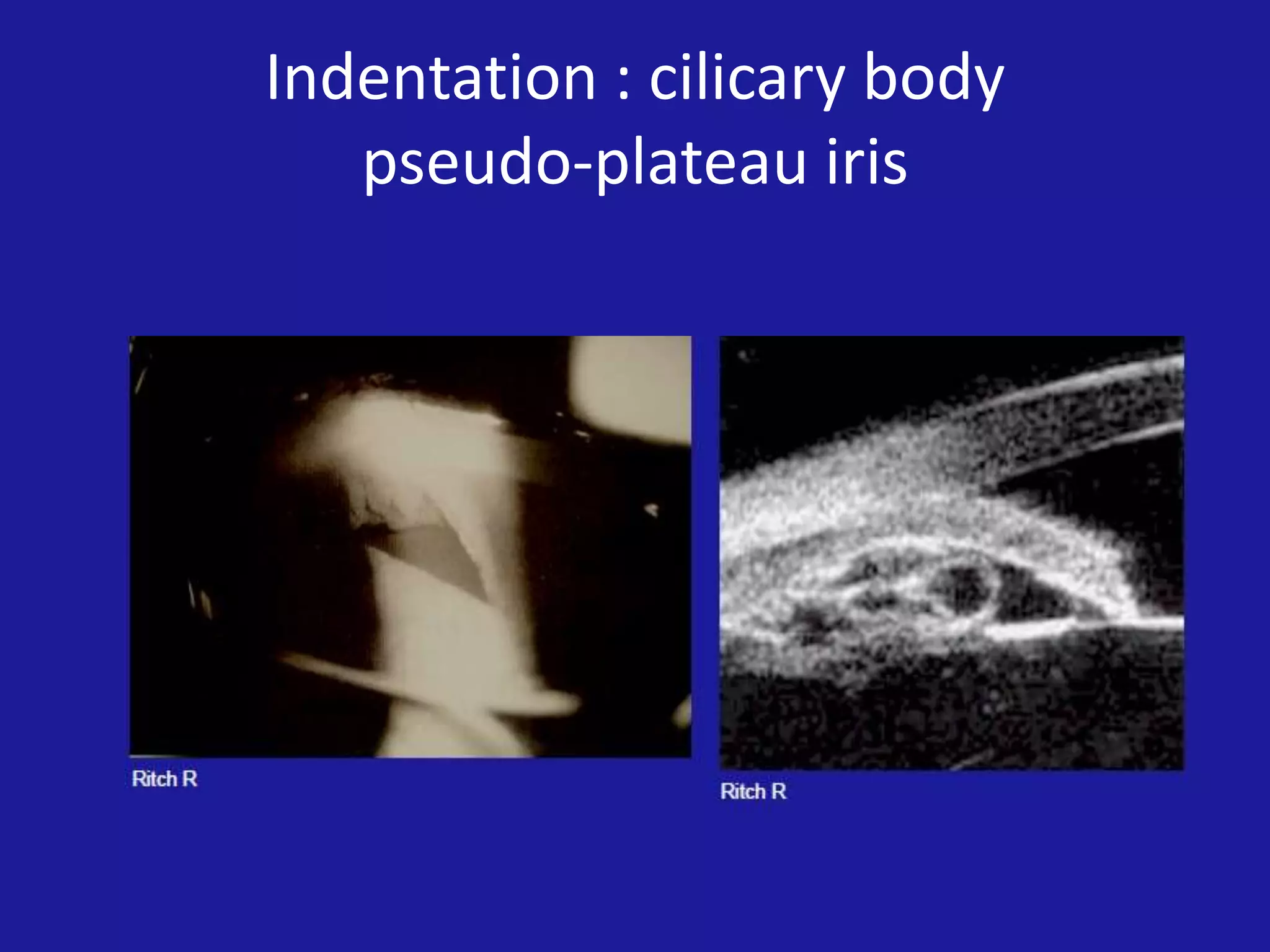 Indentation : cilicary body
pseudo-plateau iris

 