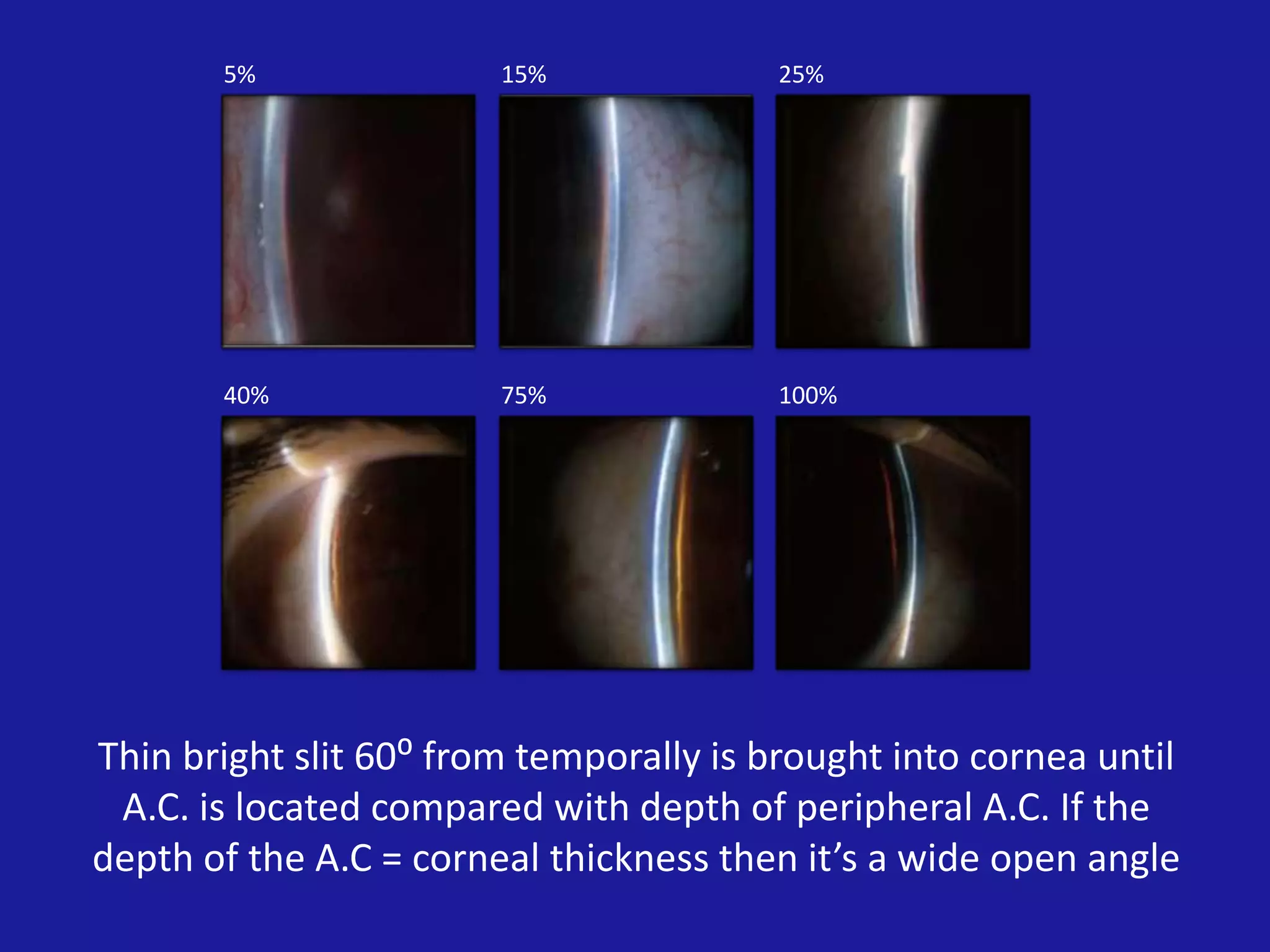 5%

15%

25%

40%

75%

100%

Thin bright slit 60⁰ from temporally is brought into cornea until
A.C. is located compared with depth of peripheral A.C. If the
depth of the A.C = corneal thickness then it’s a wide open angle

 