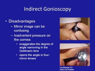 Indirect Gonioscopy

 