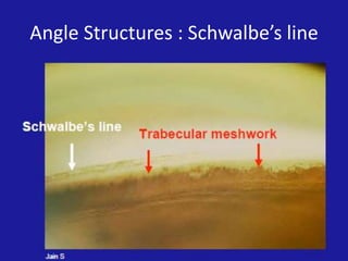 Angle Structures : Schwalbe’s line

 