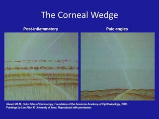 Gonio Gonioscopy Corneal Wedge
