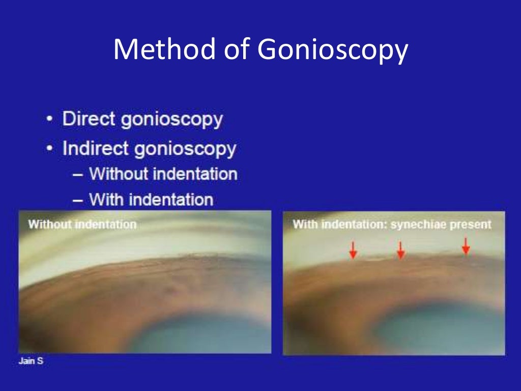 Gonioscopy