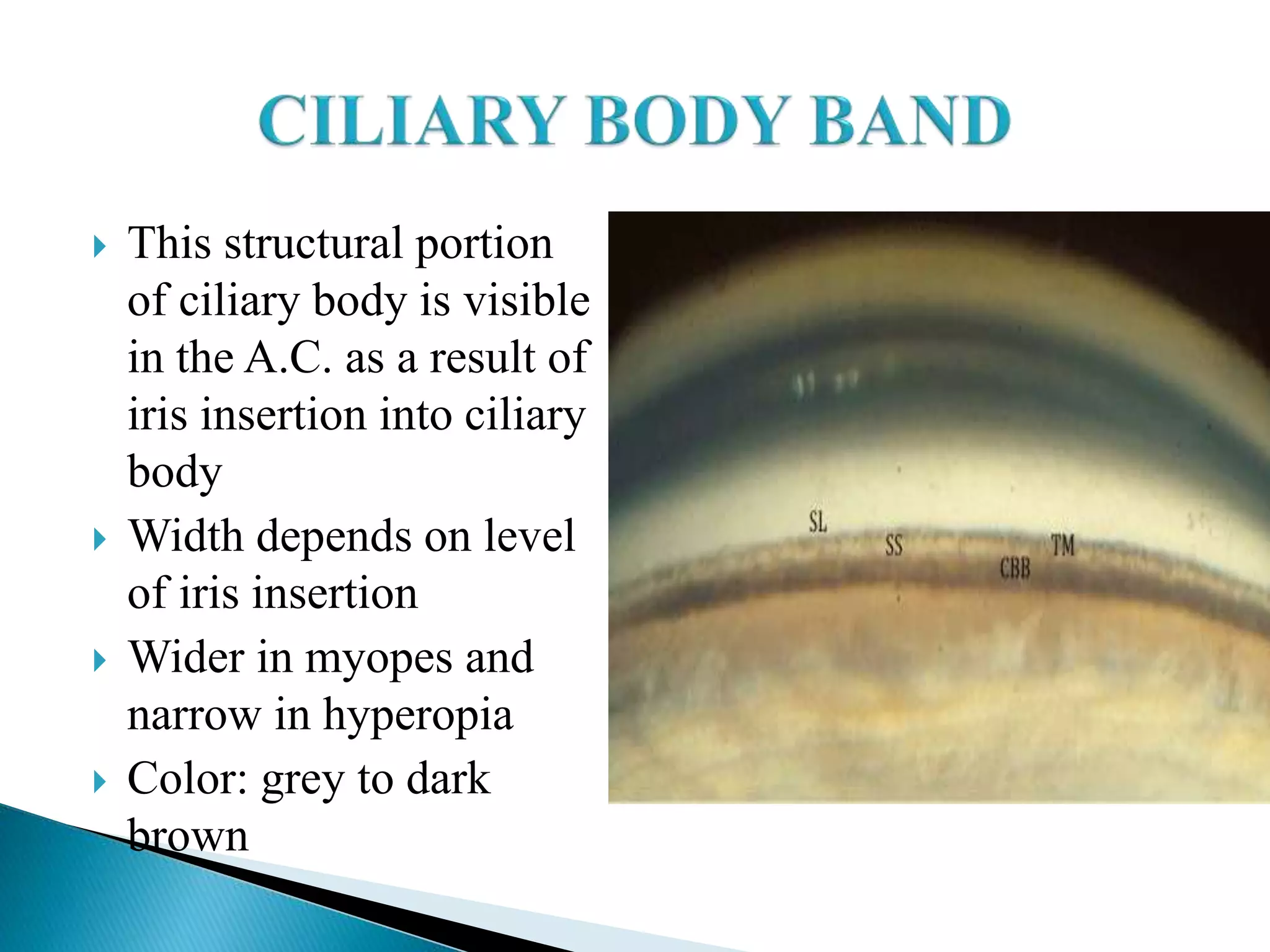  This structural portion
of ciliary body is visible
in the A.C. as a result of
iris insertion into ciliary
body
 Width depends on level
of iris insertion
 Wider in myopes and
narrow in hyperopia
 Color: grey to dark
brown
 